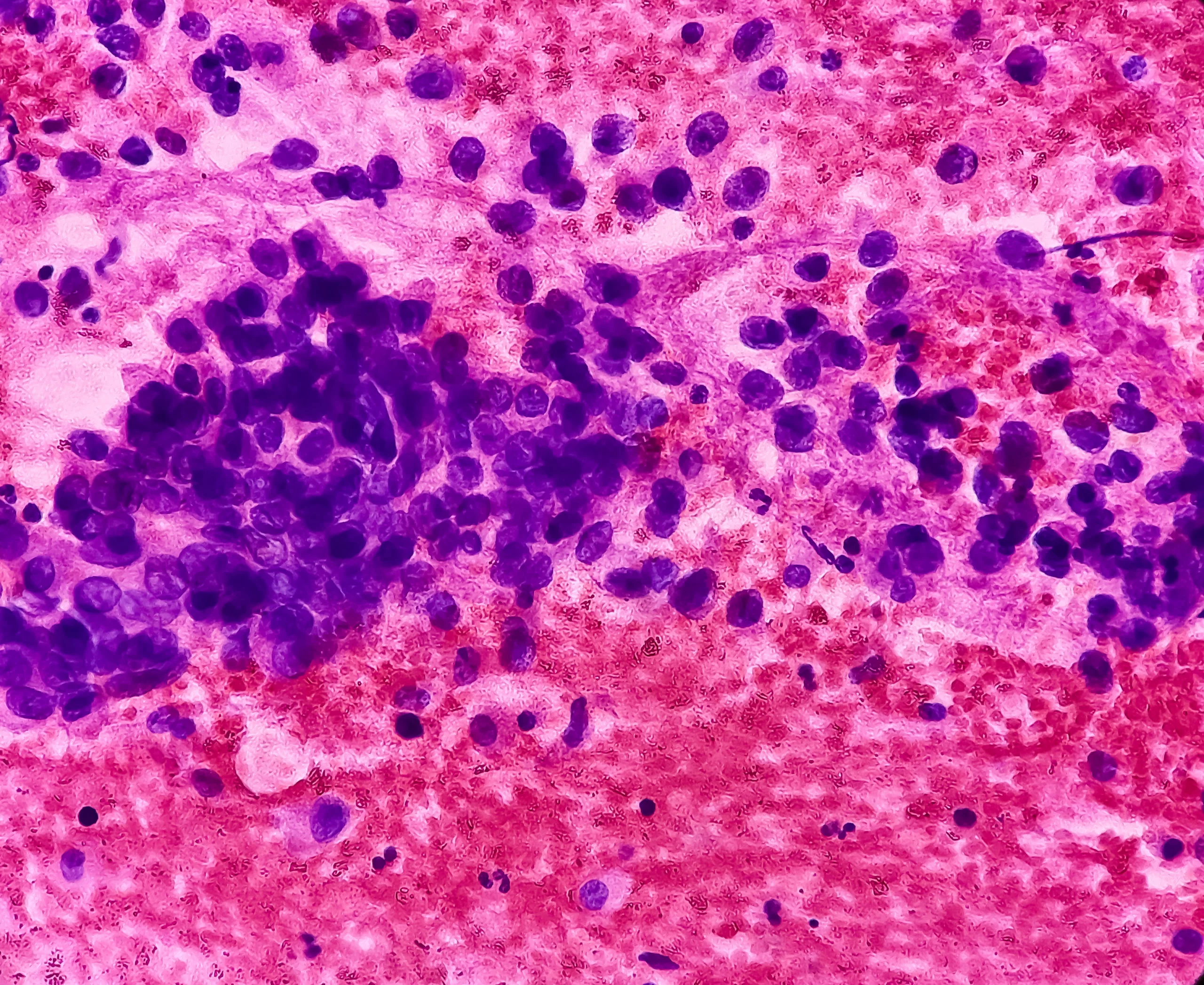 Cancer du poumon sans tabac : une mutation héréditaire multiplie fortement le risque