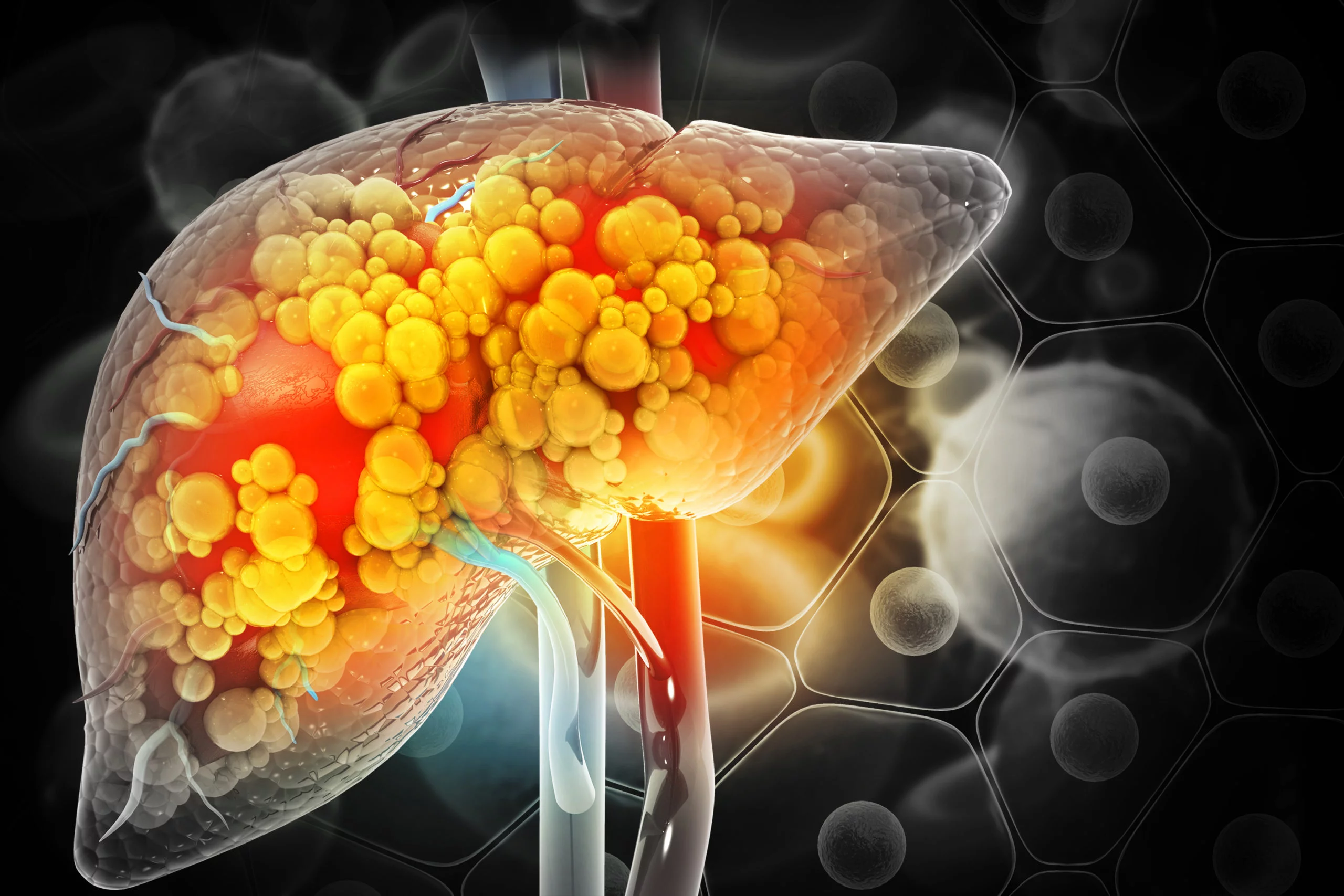 Cancer du foie : l’immunothérapie peut-elle élargir l’accès à la transplantation ?