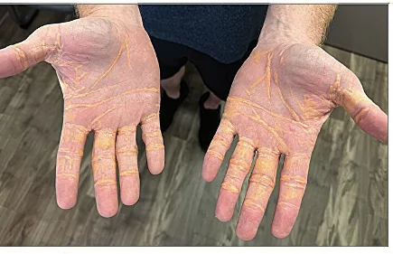 D’étranges nodules jaunes sur la peau (cas patient)