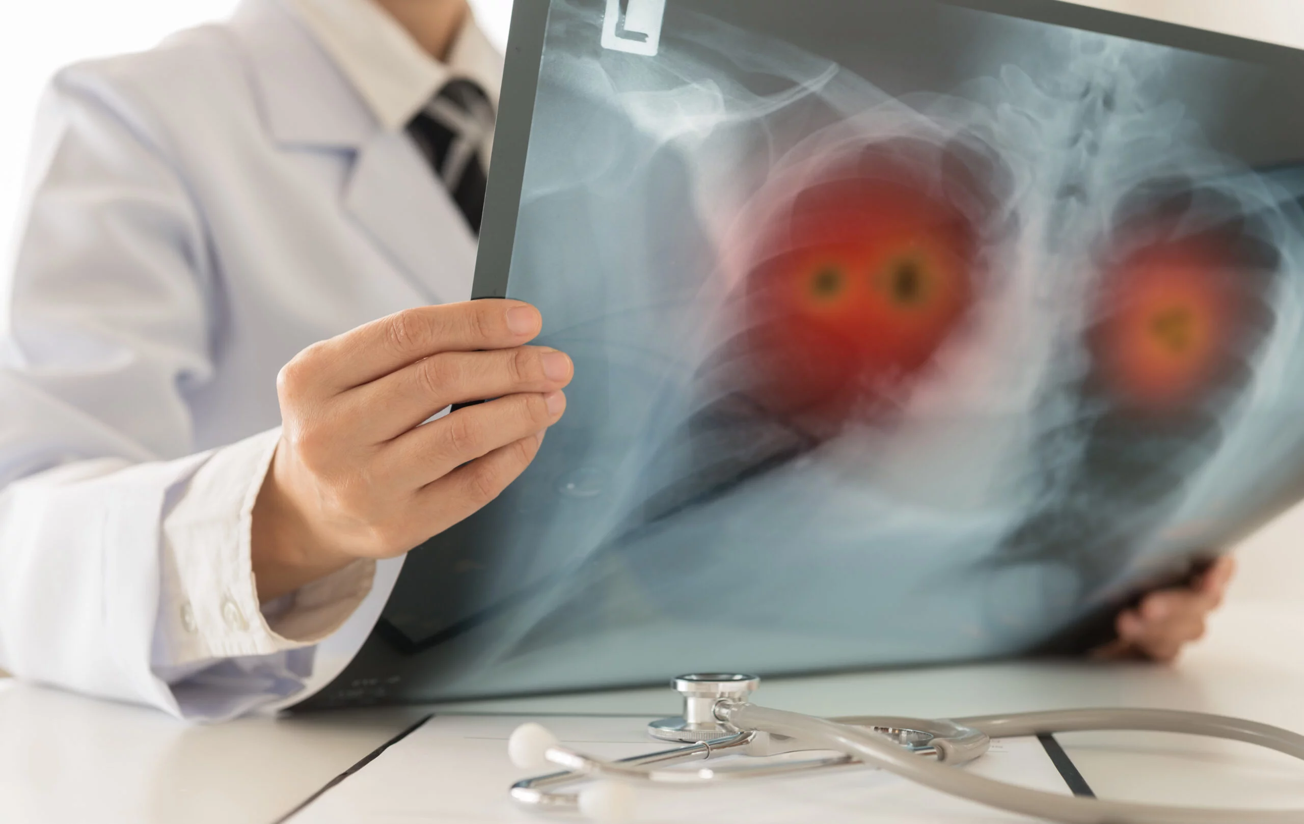 Cancer du poumon métastatique limité aux poumons : une transplantation peut-elle changer le pronostic ?