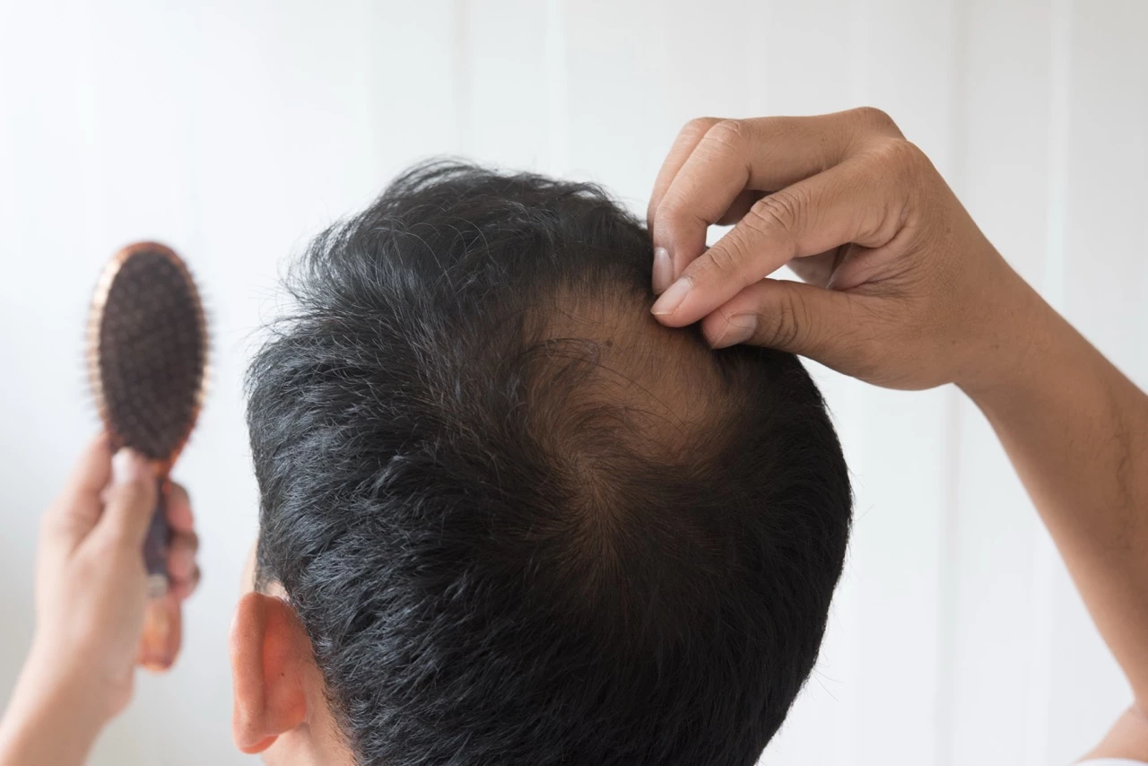 Alopécie : une repousse complète des cheveux observée