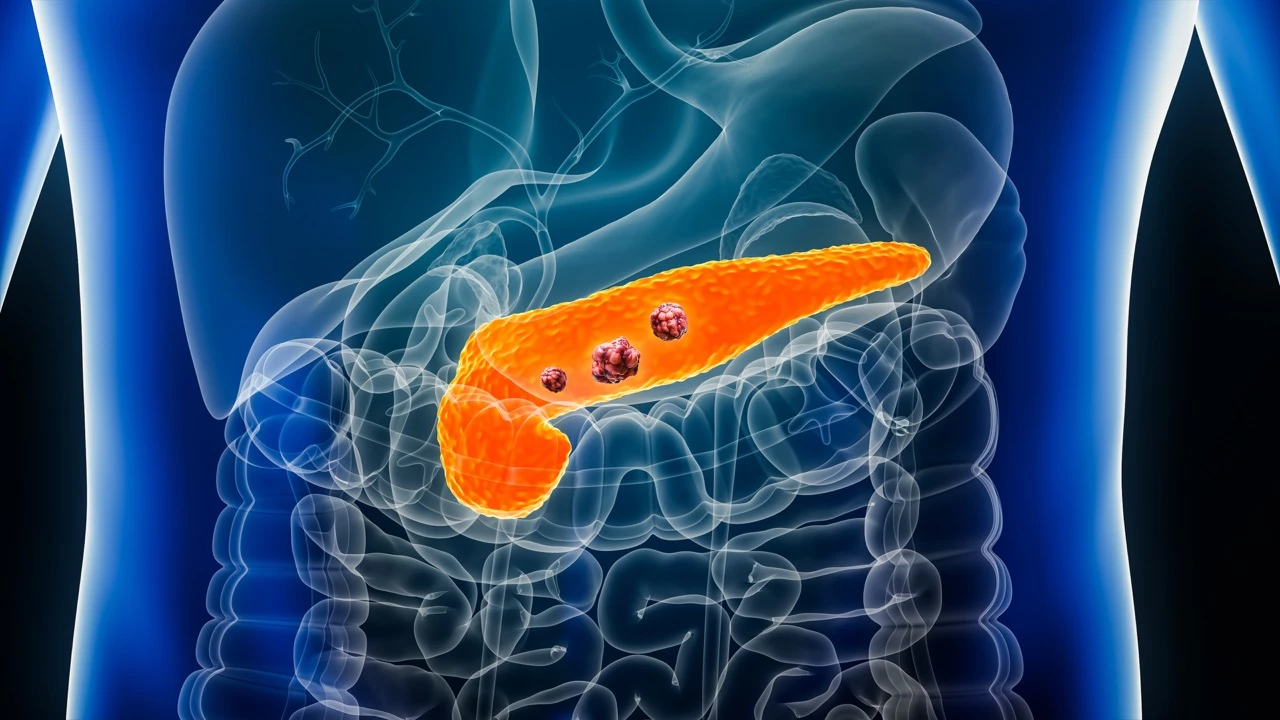 Cancer du pancréas : un virus oncolytique ajoute un signal encourageant