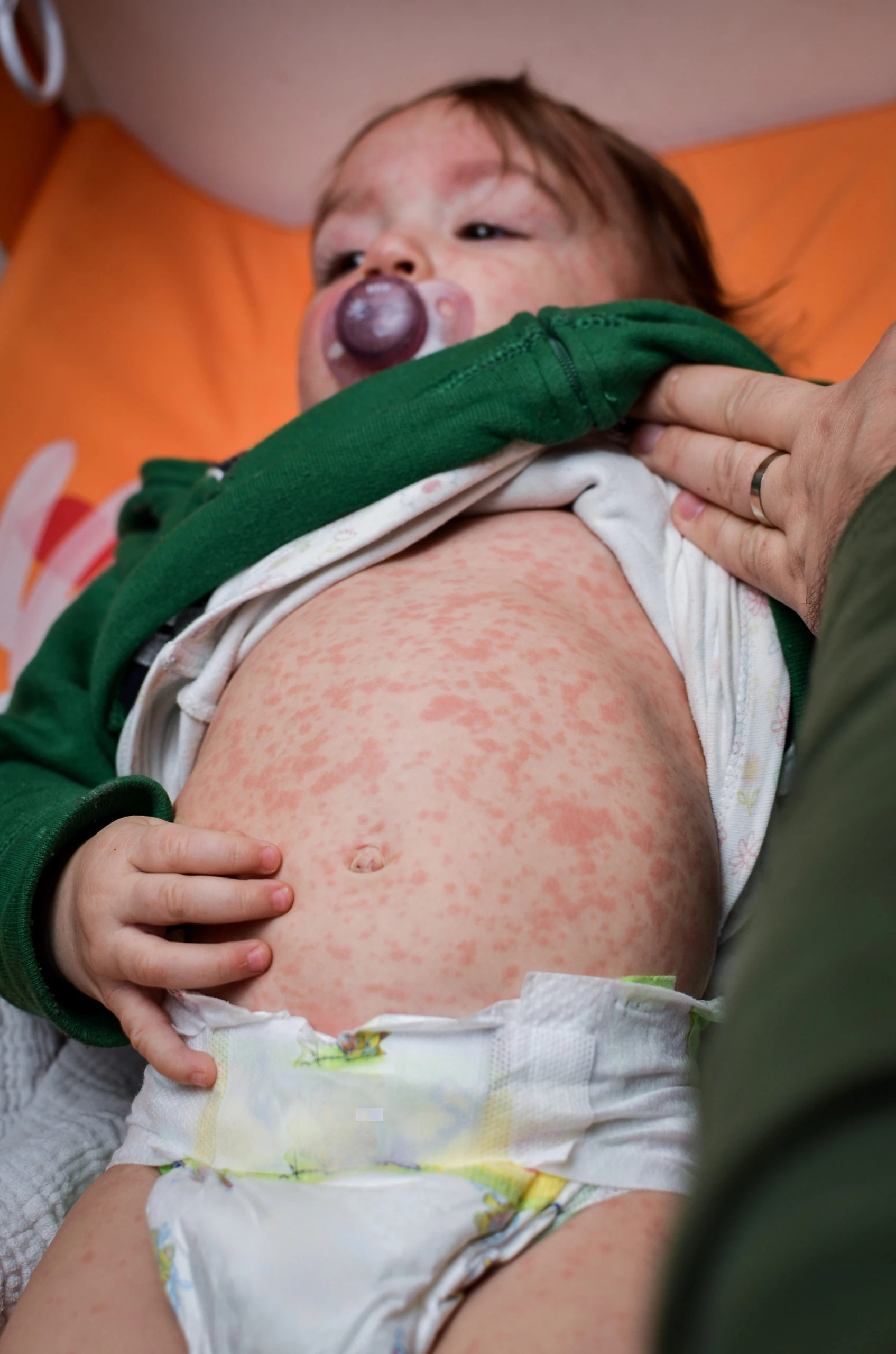 Vaccin ROR : impact du retard de vaccination