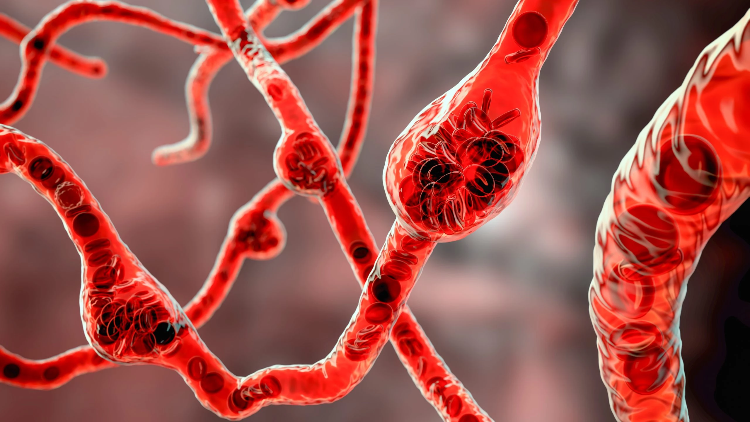 Score CAC : pas d’avantage démontré sur les événements cardiovasculaires