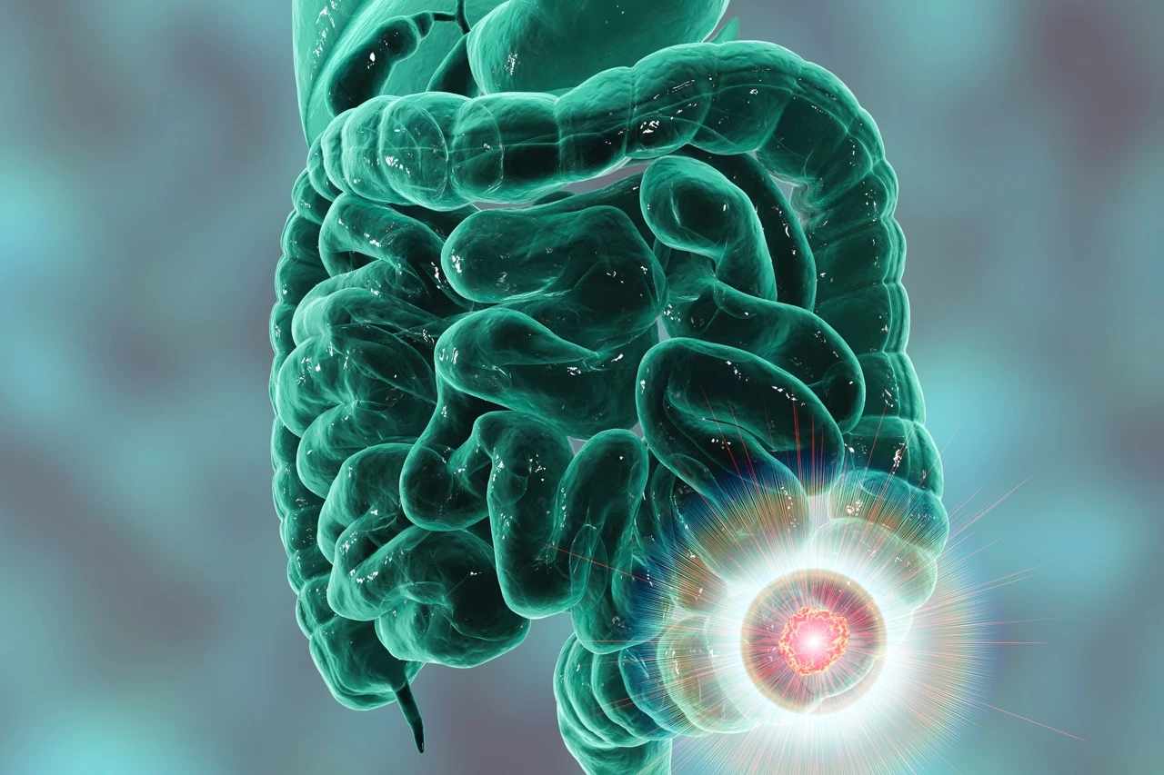Colorectale kanker op jongere leeftijd: rigiditeit van het colon als nieuwe alarmsignaal