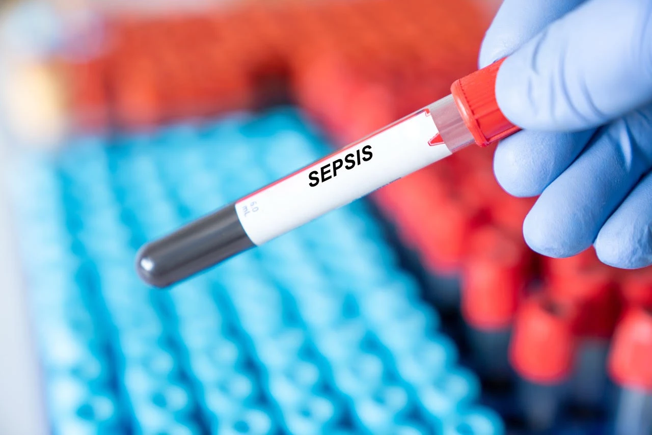 Sepsis : la procalcitonine incite à arrêter plus tôt les antibiotiques